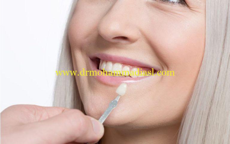 tooth shade selector 768x480 1 1